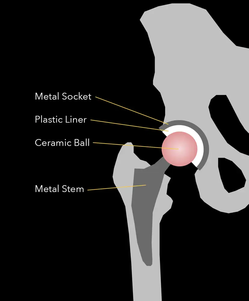 Hip Replacement
