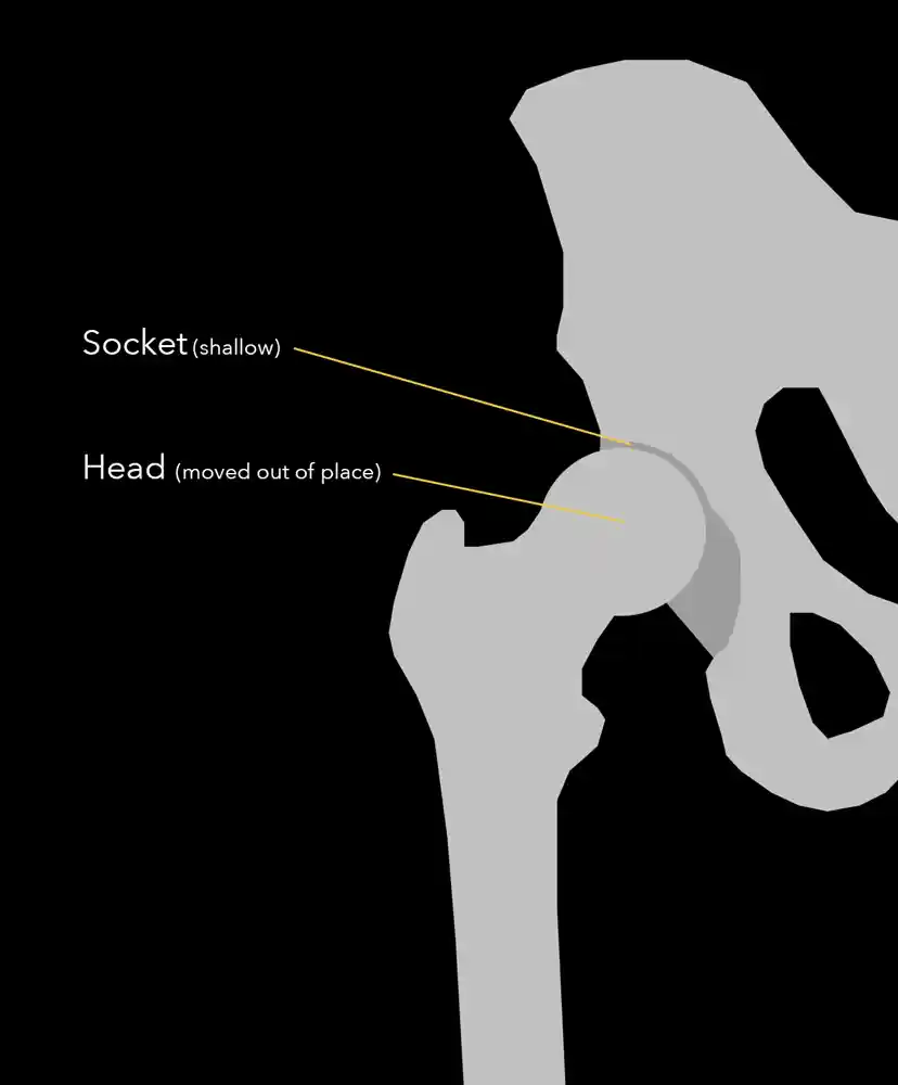 Hip Dysplasia