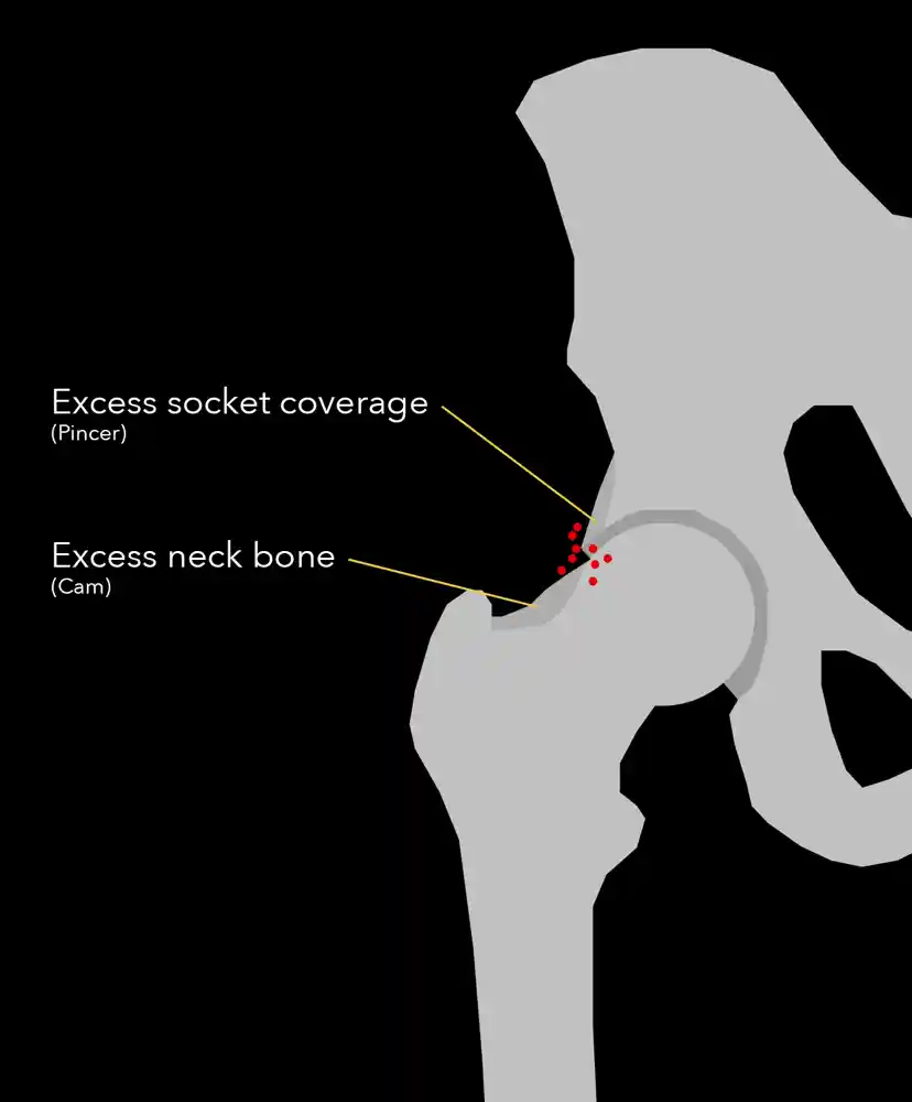 Hip Impingement